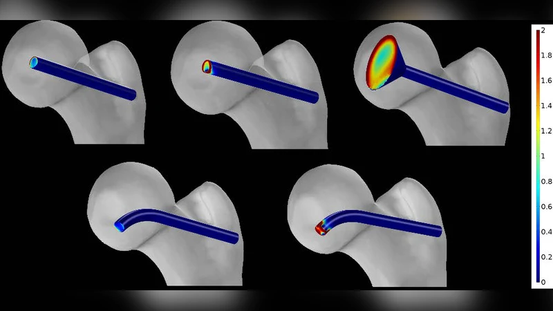 곡선형 드릴링을 활용한 대퇴골두 무혈관성 괴사 치료의 생체역학적 혁신