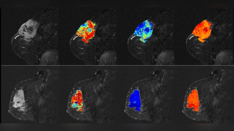 종양 연결망 분석을 통한 유방암 신경항암 반응 예측