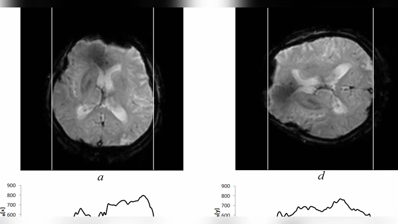 뇌관류 MR 영상 자동 ROI 검출 방법