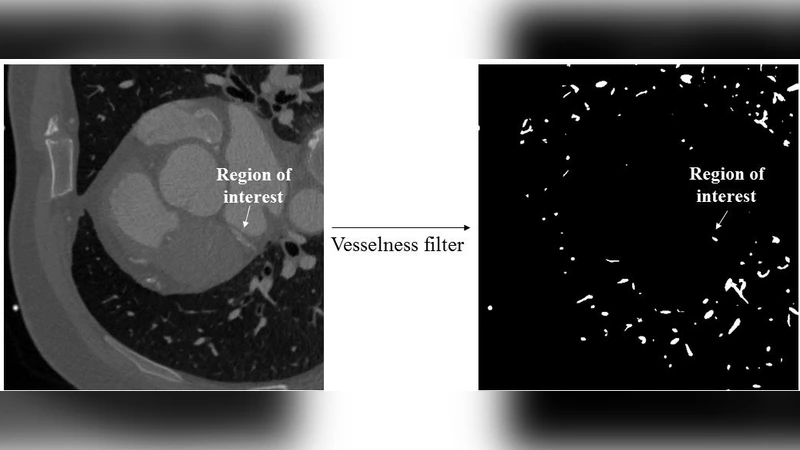 CTA 기반 관상동맥 3D 재구성 및 플라크 분석