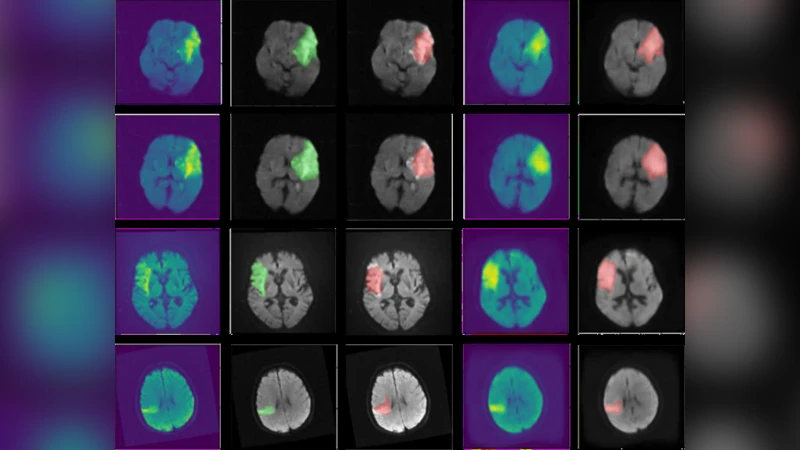 생성 모델 기반 허혈성 뇌졸중 병변 자동 분할