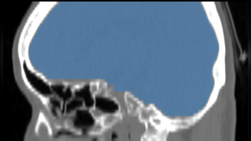 자동 뇌 영역 분할을 위한 CT 영상 처리 알고리즘