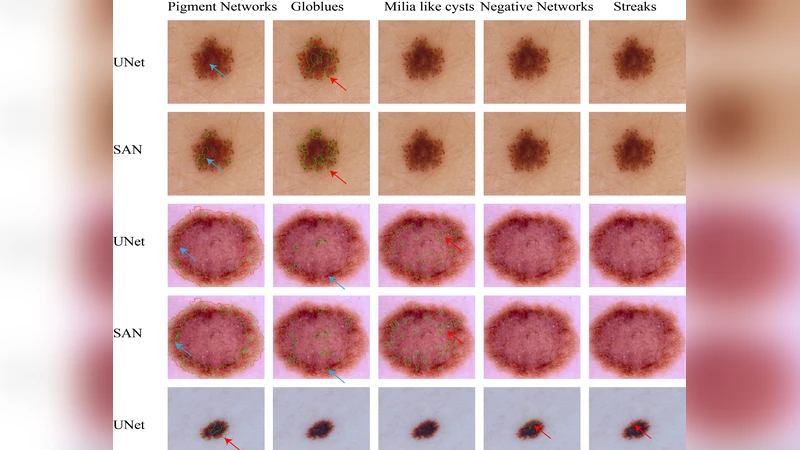 슈퍼픽셀 주의 네트워크를 이용한 피부 병변 속성 탐지