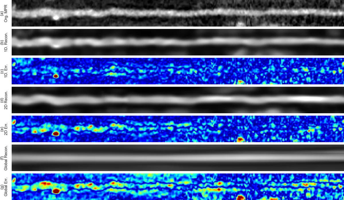 심장 CT에서 자동 심관 분석을 통한 침습적 혈관조영 필요 환자 예측