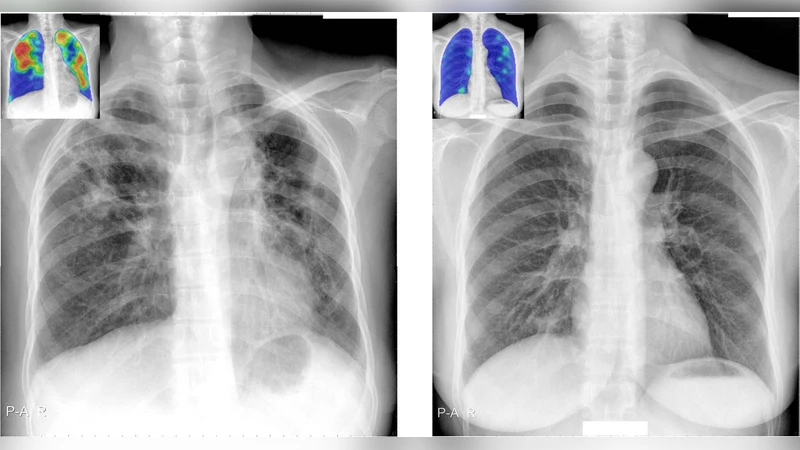 CAD4TB v6, 결핵 자동 판독의 새로운 기준