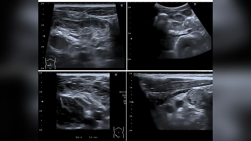 소아 충수염 초음파 자동 진단을 위한 ResNet 기반 딥러닝 모델