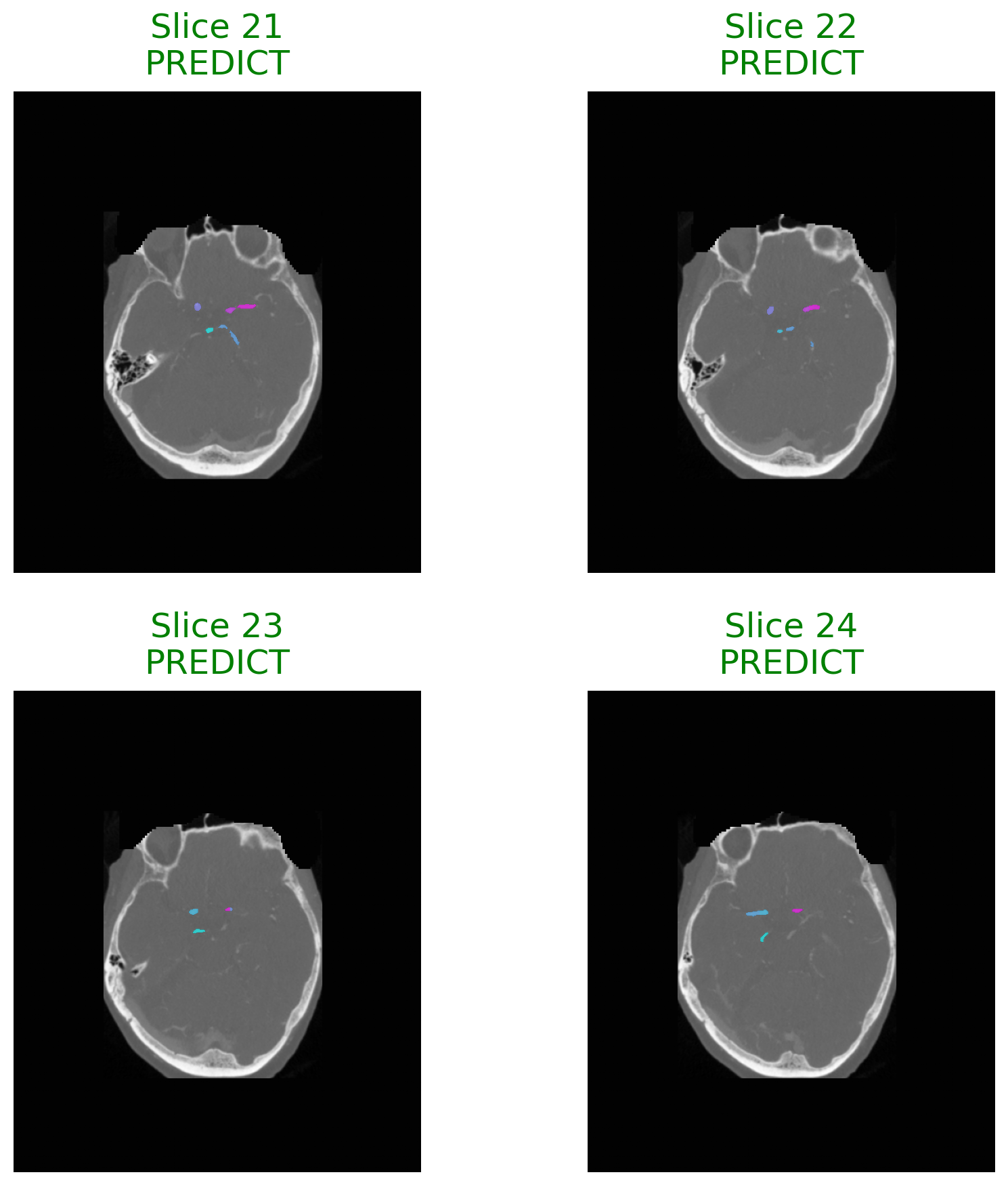 An Explainable Agentic AI Framework for Uncertainty-Aware and Abstention-Enabled Acute Ischemic Stroke Imaging Decisions
